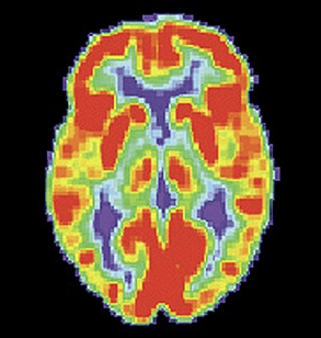 PET scan of a normal brain