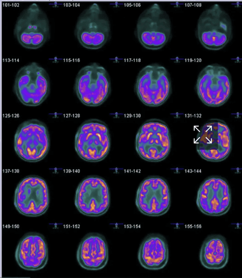 Brain PET scan